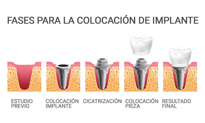 Fases colocación de implantes